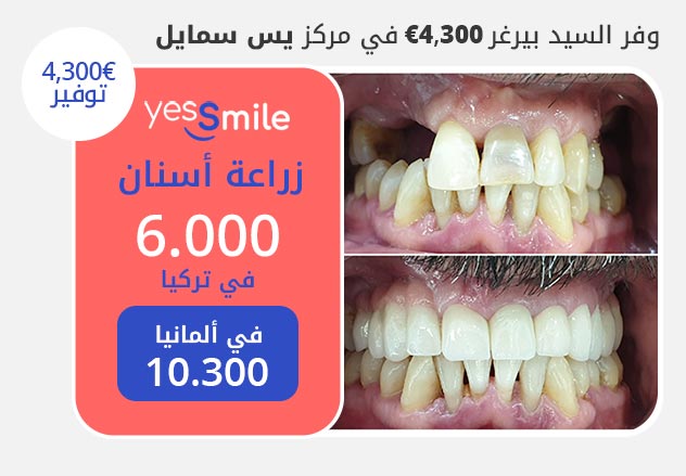 Dental Implants cost