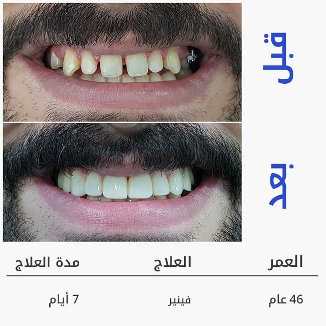 قبل وبعد تركيب فينير الاسنان 