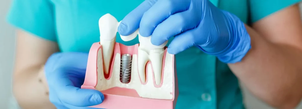 Dental-Implants-being-shown (1)