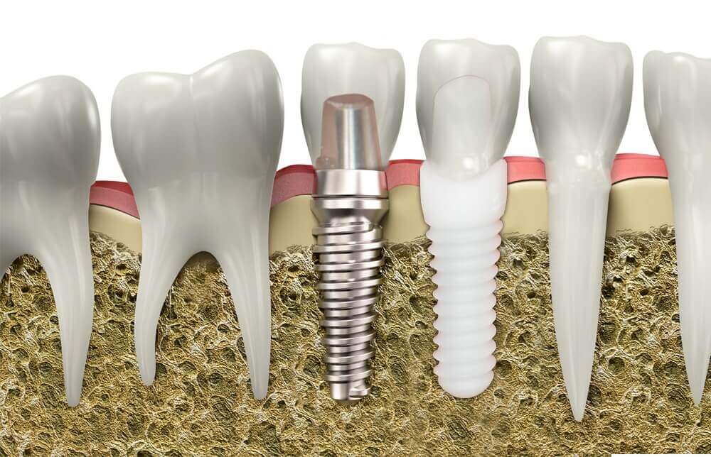 Zirconia implants