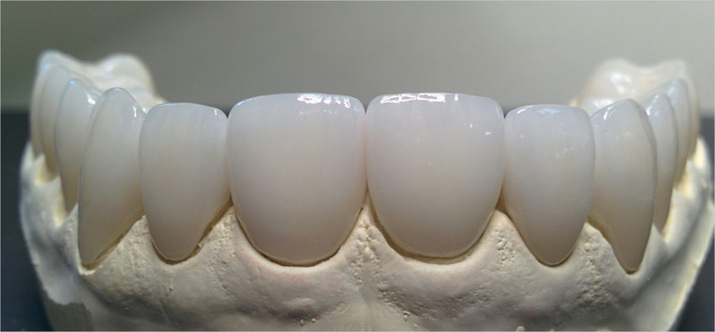 emax_veneer