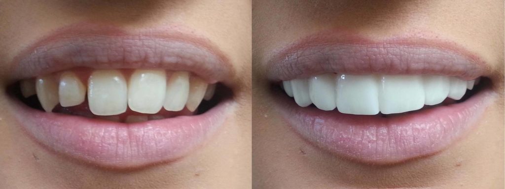 veneers-bleach-shade-before-afters