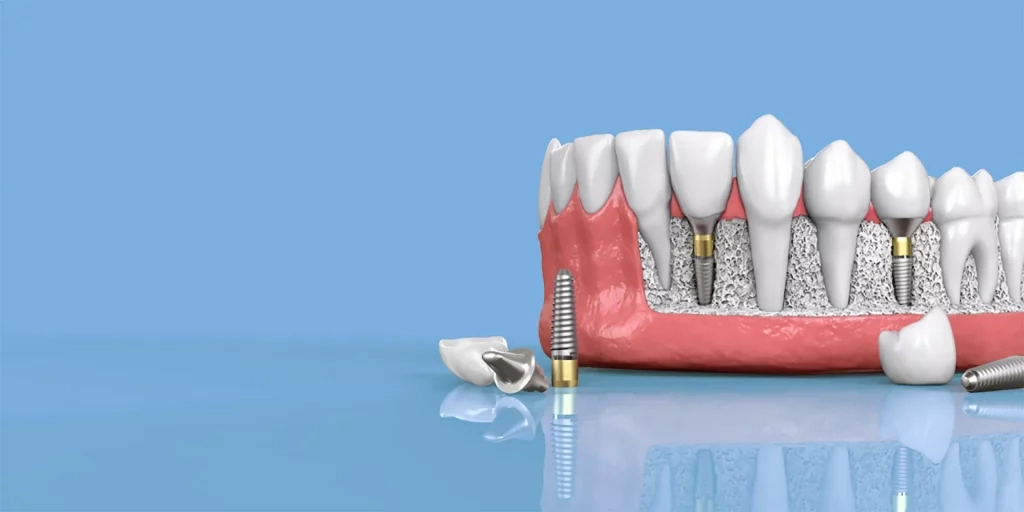 أهم تعليمات بعد زراعة الأسنان 