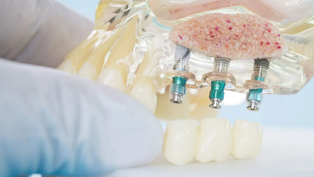 زراعة الأسنان بالخلايا الجذعية