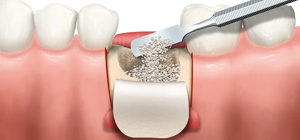 زراعة العظم في الأسنان
