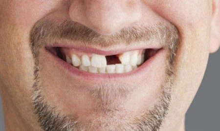 طريقة زراعة الأسنان الأمامية 