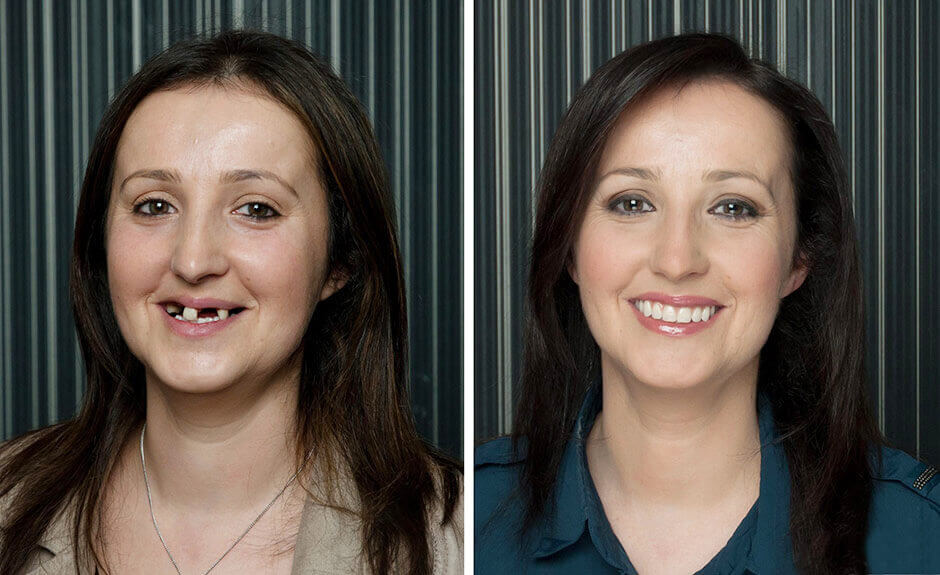 Before-After Dental Implants on the Upper Jaw