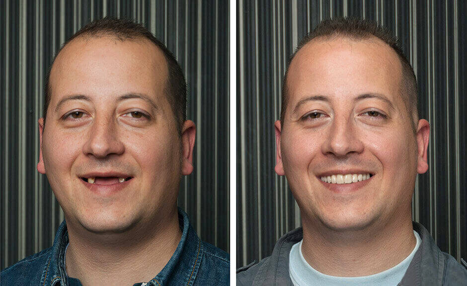 Before-After-dental implants