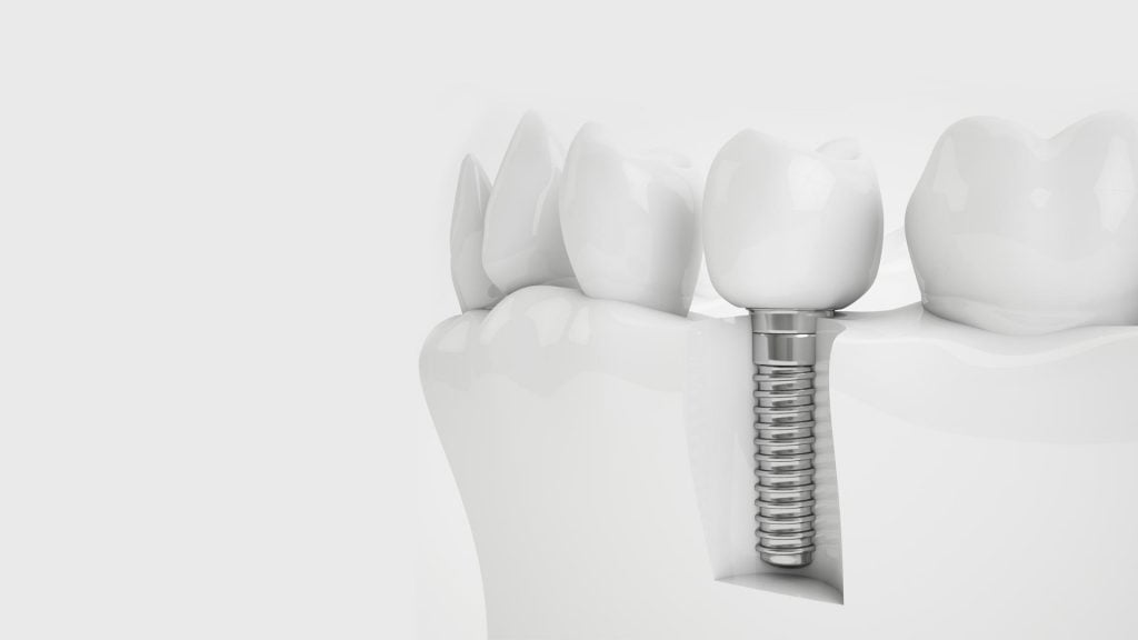 dental implant doctor check