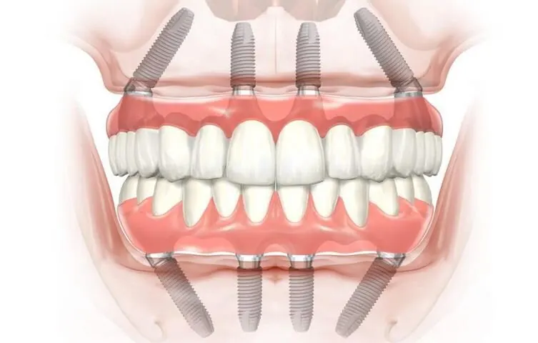 dental implant full jaw