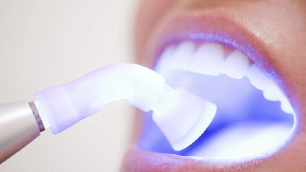 الفرق بين تبييض الاسنان بالليزر والبلازما