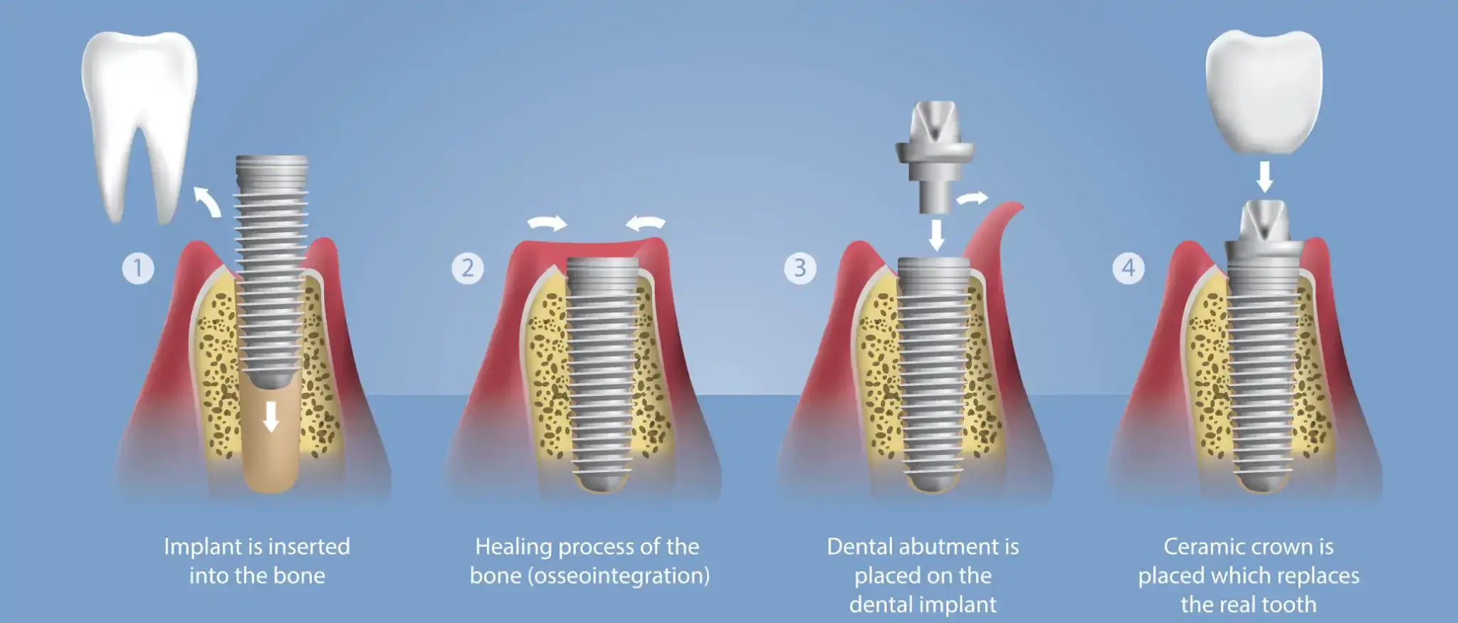 الفرق بين زراعة الاسنان والتركيب 