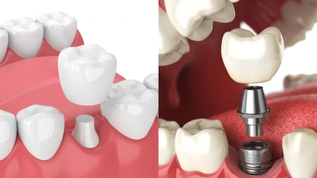 الفرق بين زراعة الاسنان والتركيبات