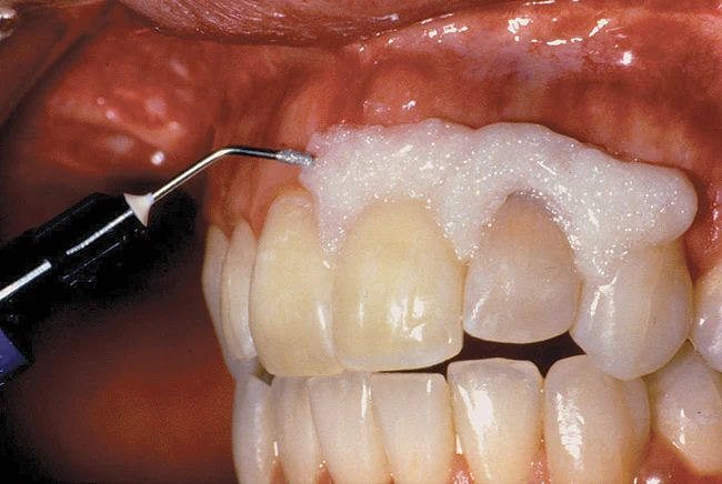 تبييض الاسنان الكيميائي