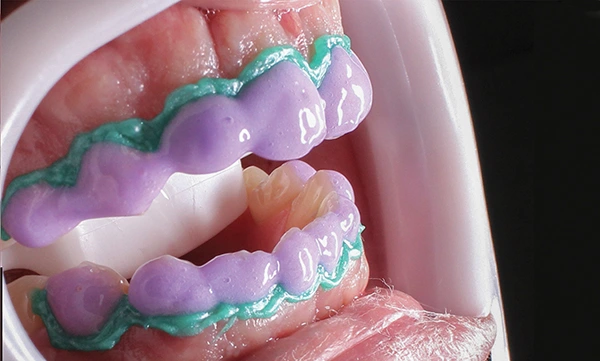 تبييض الاسنان الكيميائي