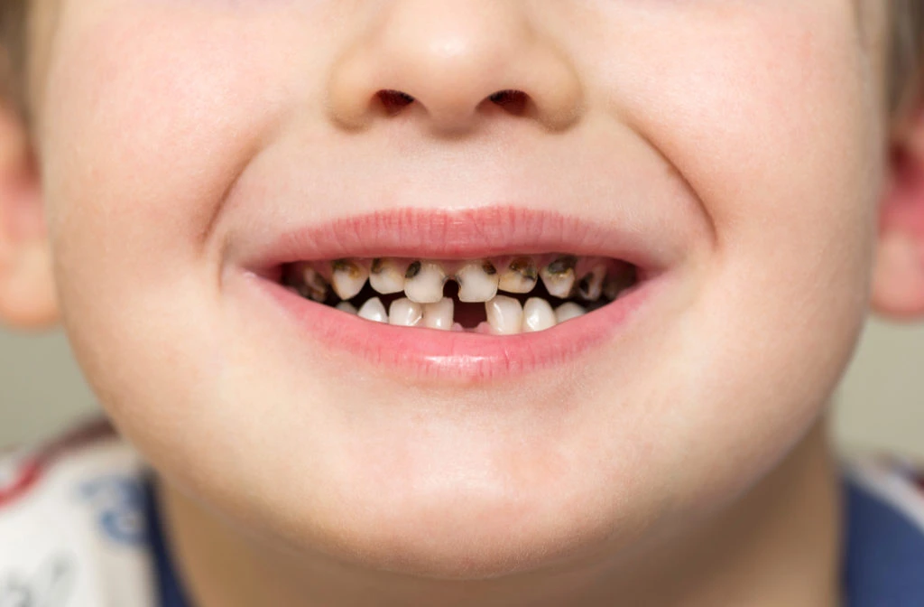 تبييض الاسنان للاطفال طبيعياً