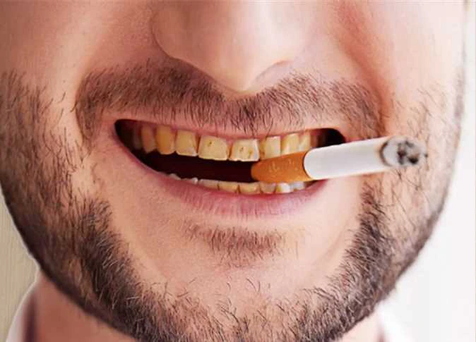 تبييض الاسنان للمدخنين