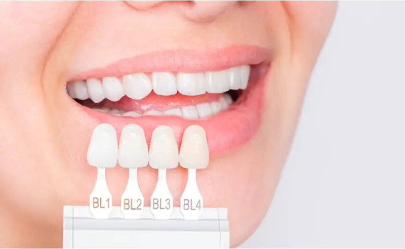 درجات تبييض الاسنان 