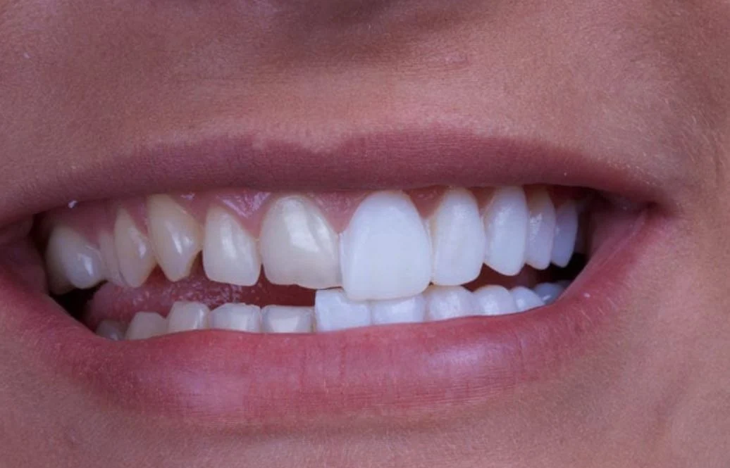 أنواع فينير الأسنان 