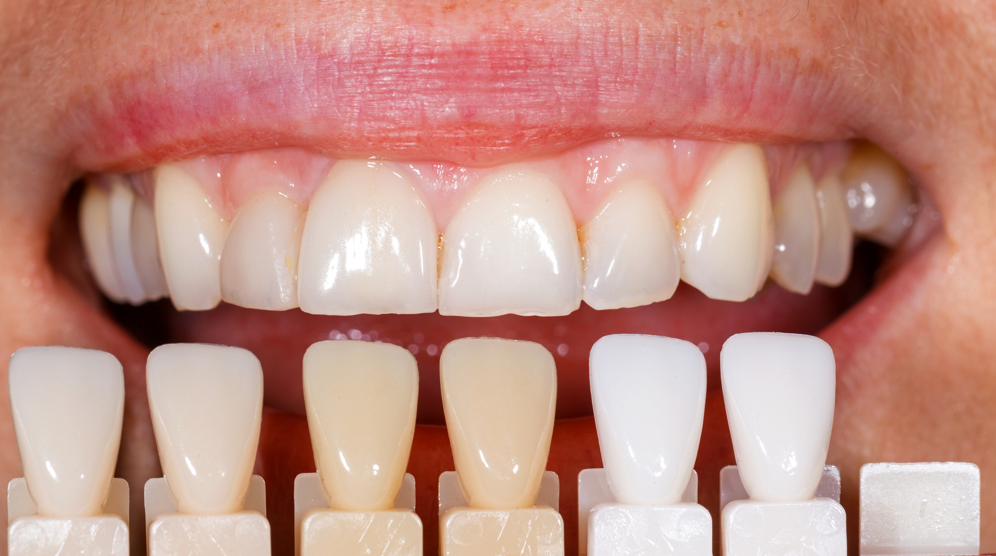 الفرق بين فينير ولومينير الأسنان 