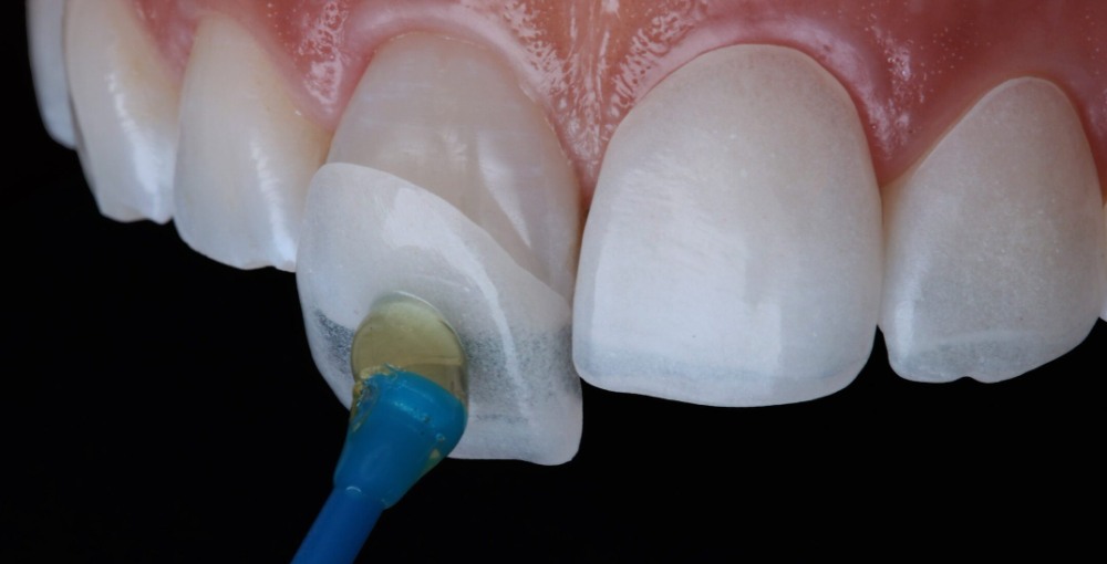 الفرق بين فينير ولومينير الأسنان
