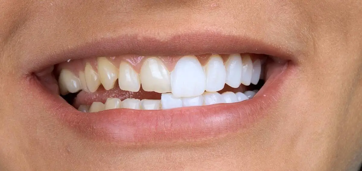 علاج بروز الأسنان الامامية