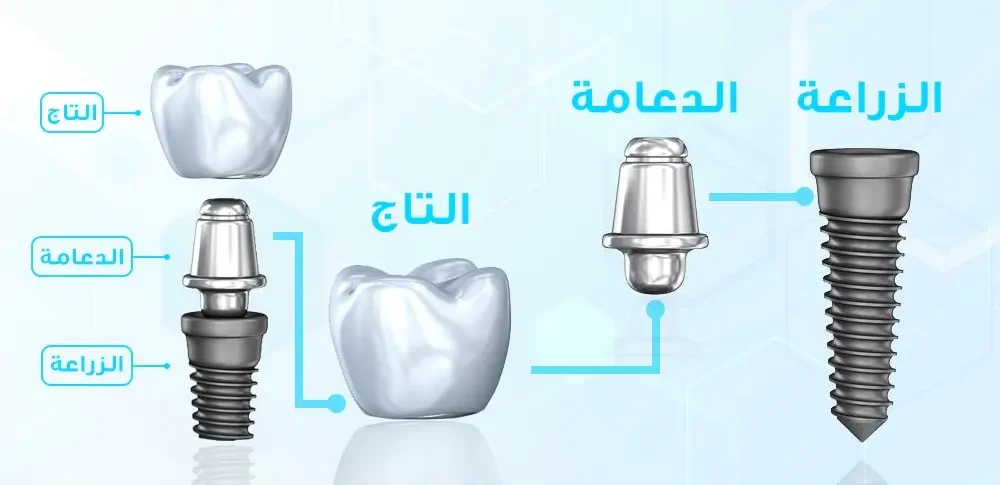 تركيبات الاسنان