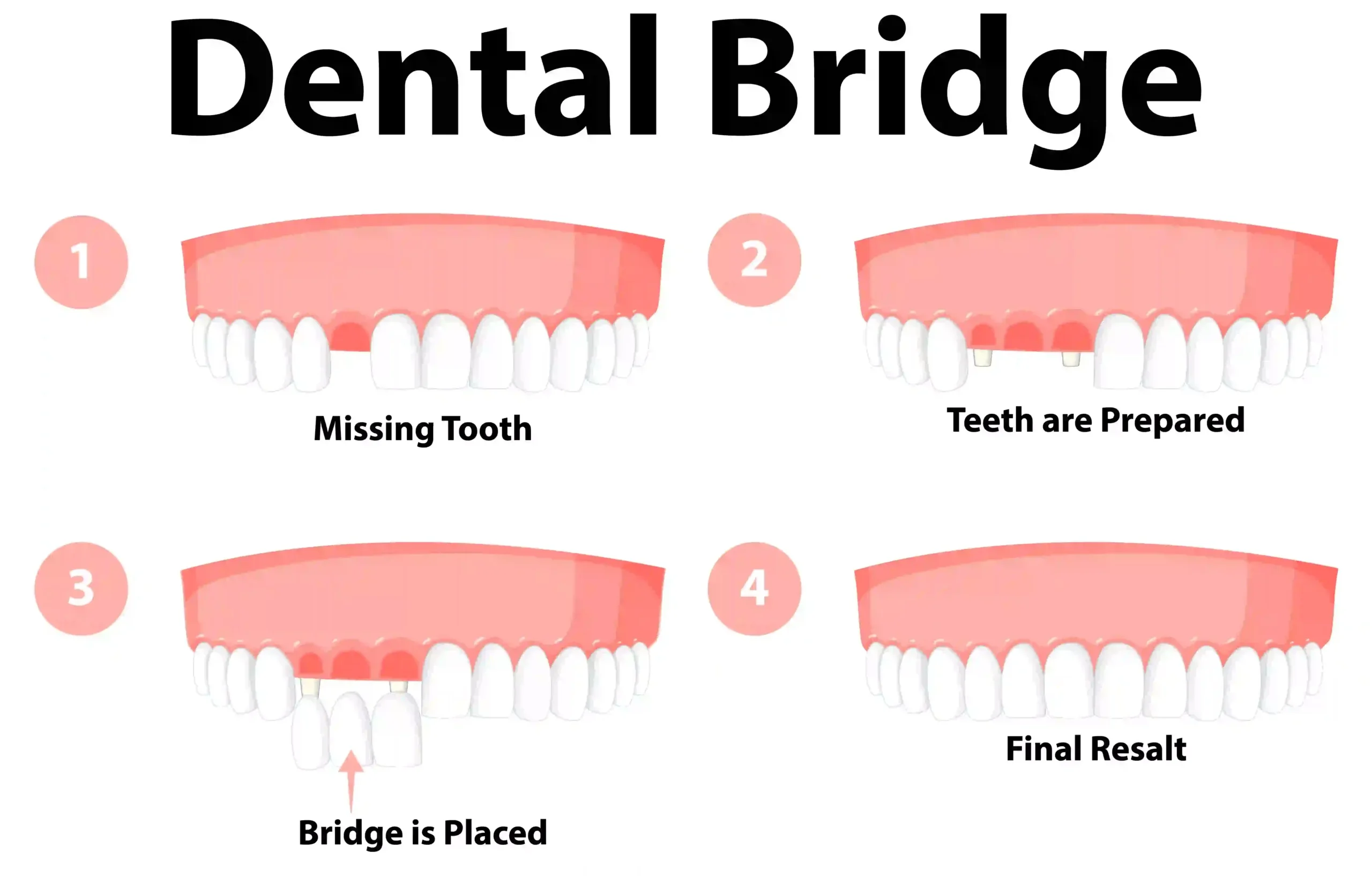 أنواع جسور الأسنان