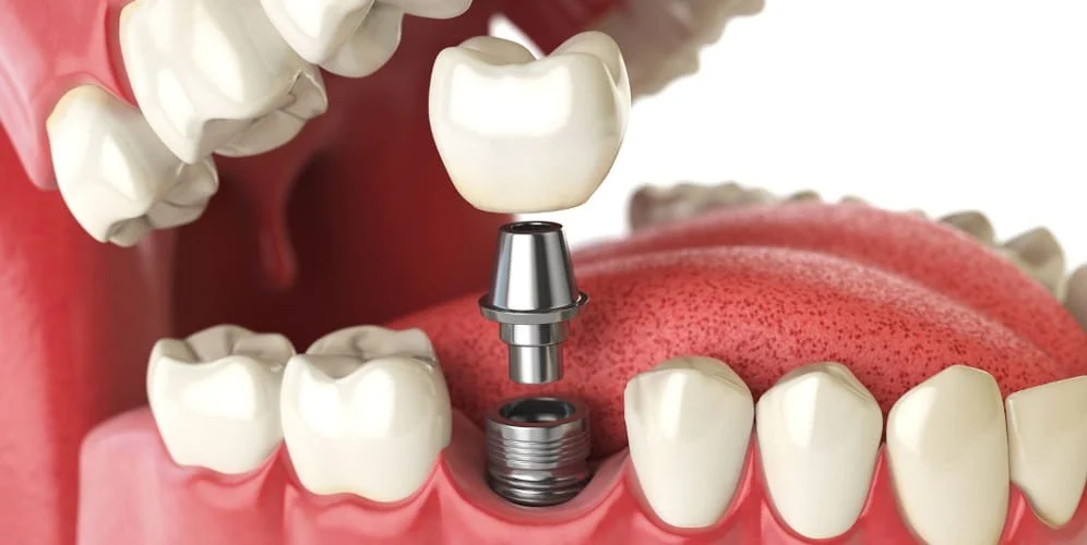 ما هي تركيبات الأسنان المعدنية؟