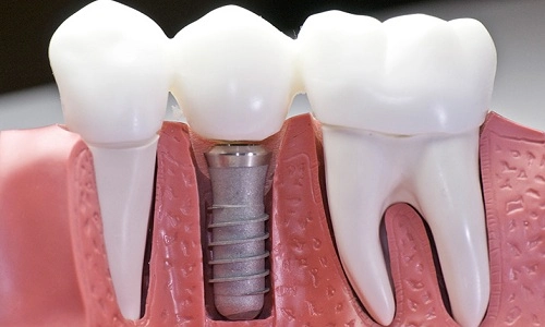 تركيبات الأسنان المعدنية مقابل الإيماكس