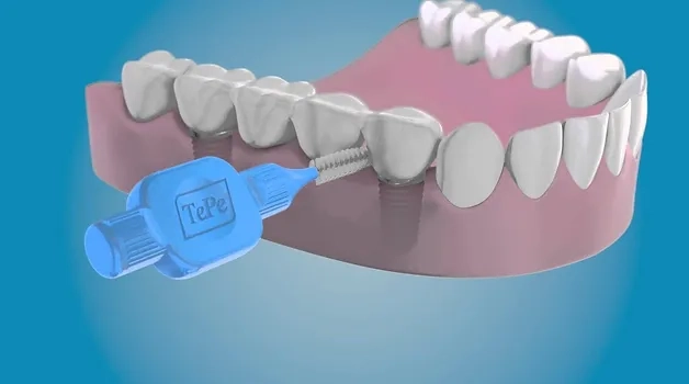 كيفية تنظيف جسر الأسنان