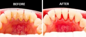 أنواع الجير في الأسنان