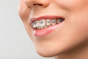 تقويم الأسنان مع وجود جسر