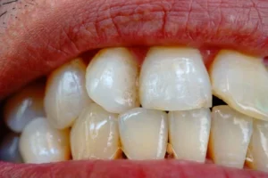 اصفرار الأسنان بعد تنظيف الجير