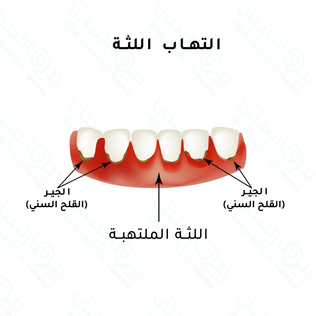 اللثة 