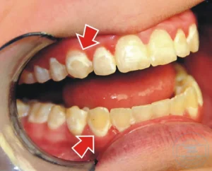 كيفية تنظيف الأسنان المركبة
