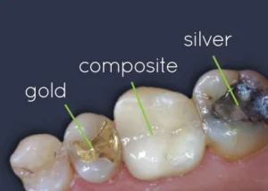 أنواع حشو الأسنان