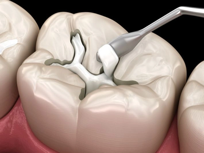 أنواع حشوات الأسنان