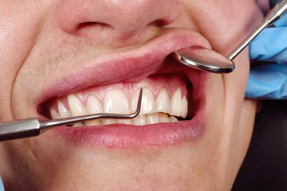 إزالة الجير الصلب من الأسنان