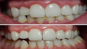 التخلص من الجير في الأسنان طبيعياً
