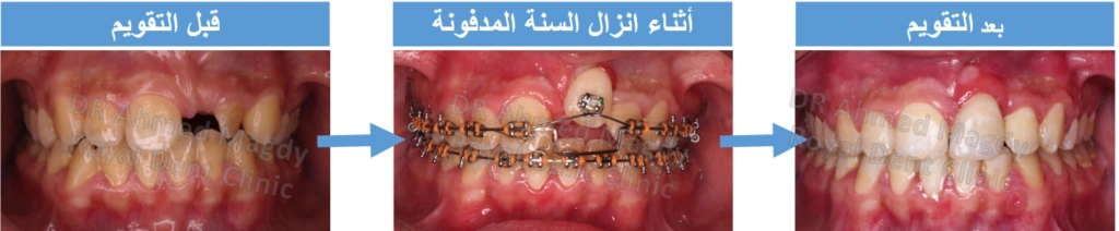 جراحة الأسنان المدفونة
