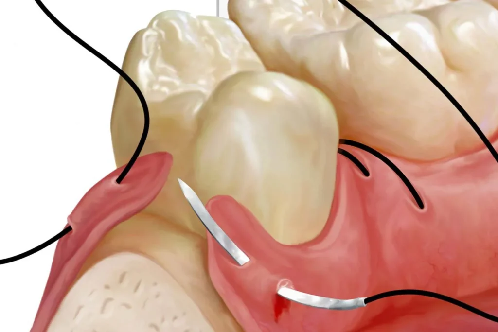 خيط جراحة الأسنان