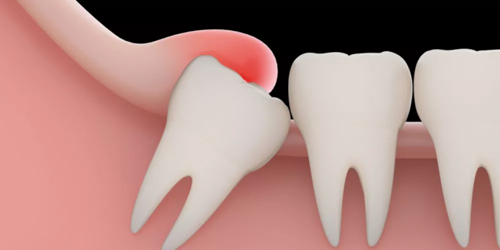 علاج جراحة الأسنان