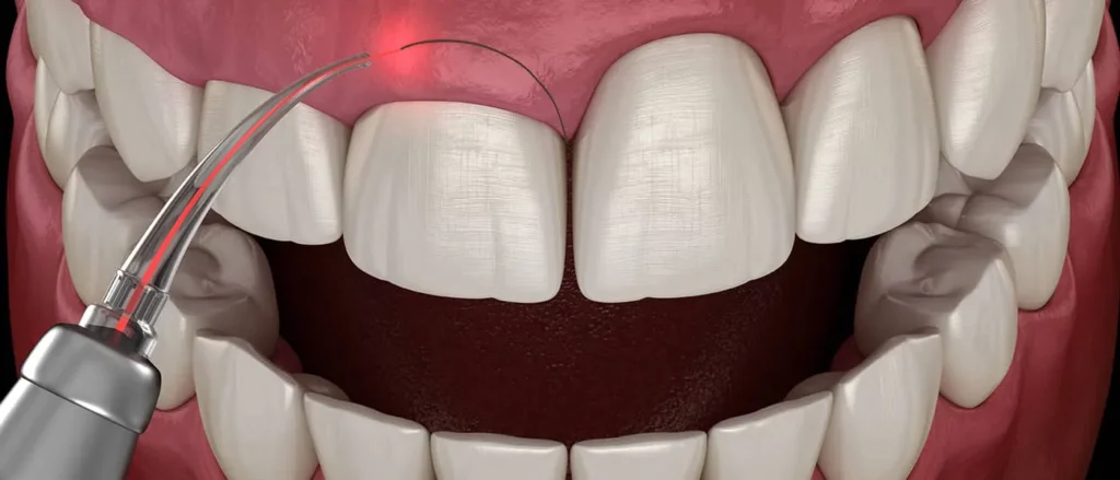 جراحة لثة الاسنان 