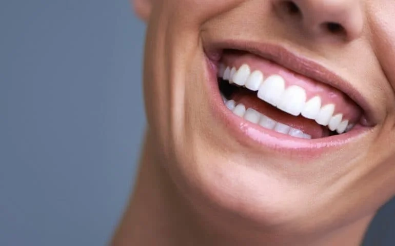 أشياء يجب معرفتها قبل تركيب فينير الاسنان