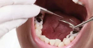 طريقة تنظيف الأسنان من التسوس عند الطبيب | مركز يس سمايل