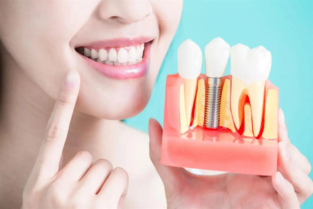 Everything you need to know about dental implants and their importance