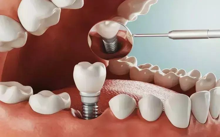 دعامات الأسنان | كيف تمنحك ابتسامة طبيعية ومتناسقة؟
