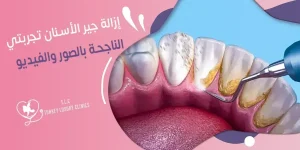كيف أحافظ على جمال ابتسامتي؟ تجربتي مع إزالة الجير