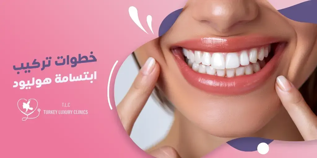 تعرف على شروط تركيب ابتسامة هوليود
